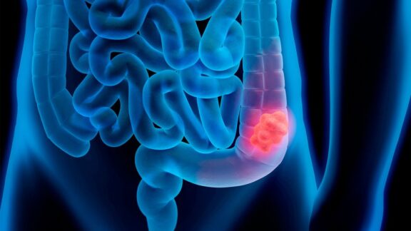 78802-campania-de-prevencion-del-cancer-de-colon-en-el-hospital-senior-del-milagro